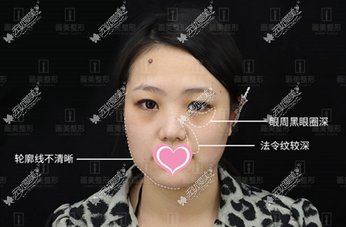 5d面部提升前状态