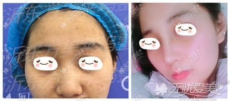 临沂东方美莱坞鼻综合案例