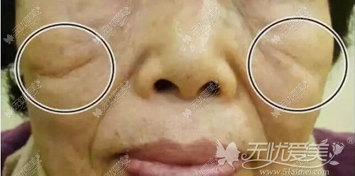 印第安纹形成原因