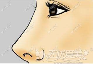 韩国will整形医院隆鼻