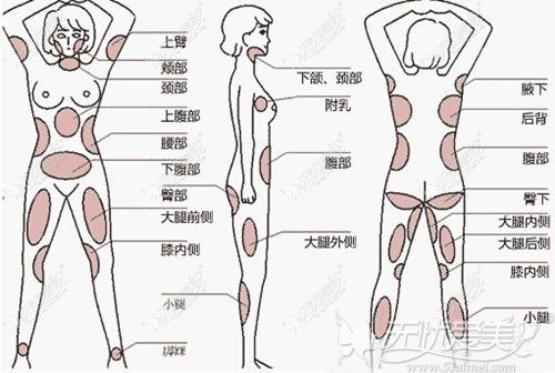 全身吸脂手术的部位