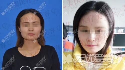 东营艺美自体脂肪移植案例