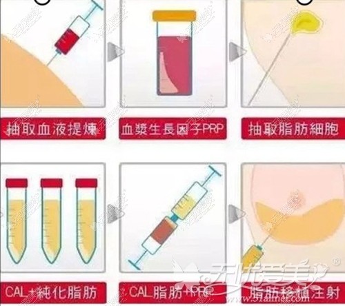 东营艺美prp自体脂肪移植过程