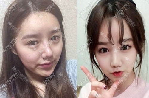 韩国id整形医院颧骨整形案例