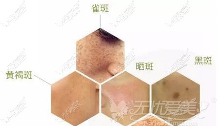 温州星范激光祛斑