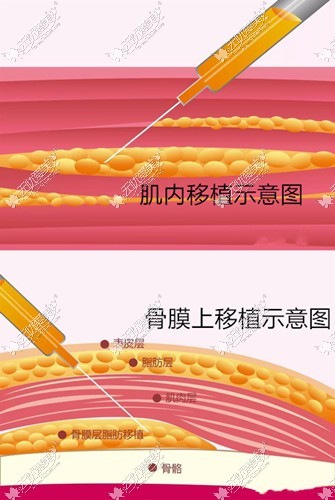 王东院长脂肪填充注射的部位