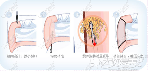 手臂吸脂手术过程