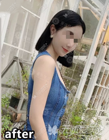 做完手臂吸脂手术后