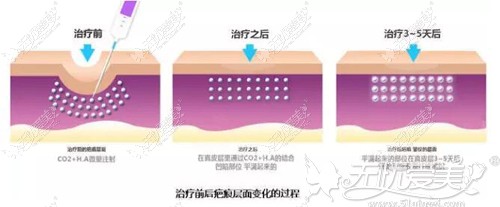疤痕针原理