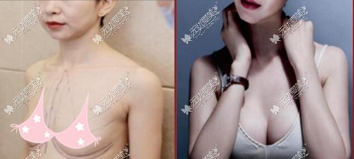 成都纽莱茵假体丰胸对比案例