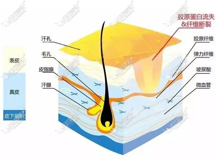 成都军建医院治疗凹疤原理51aimei.com