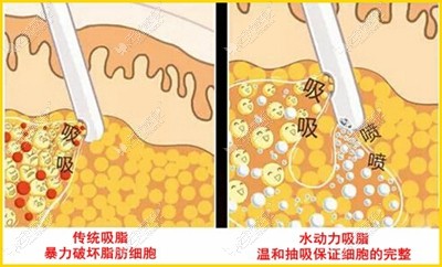 安阳苏莱美水动力腰腹吸脂