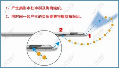 安阳苏莱美360水动力腰腹吸脂