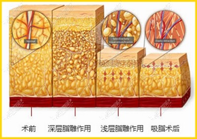 安阳苏莱美吸脂