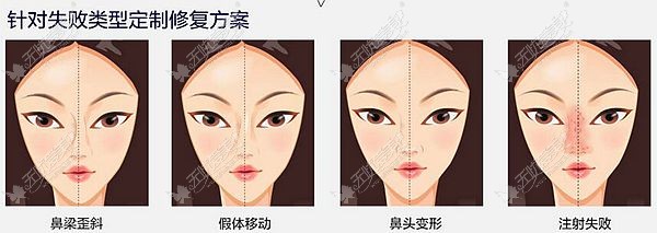 鼻部综合修复