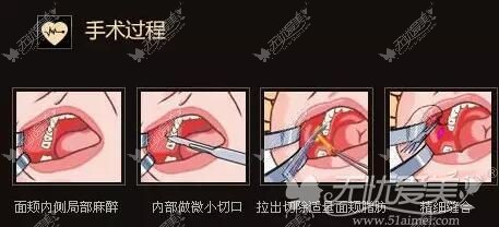 去颊脂垫瘦脸过程