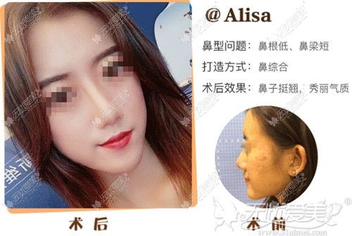 鼻综合手术案例