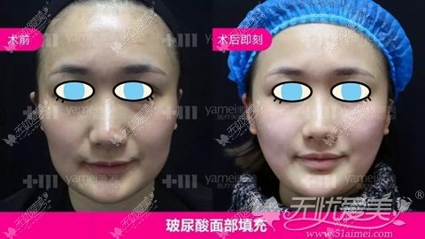 长沙雅美面部填充<span style=