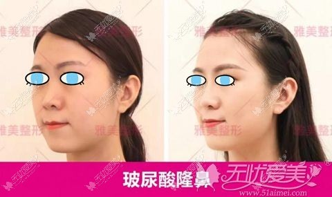 长沙雅美玻尿酸隆鼻<span style=