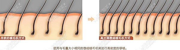 高兰得细微植毛机