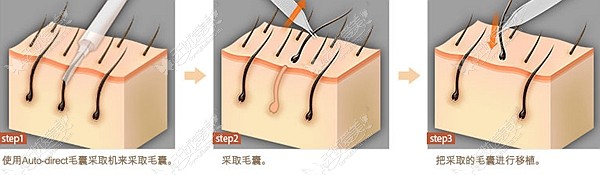 非切割毛发移植