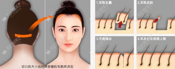 无痕缝合技术