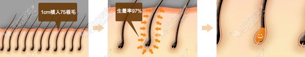 Slit毛发移植的优点