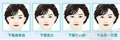 下颌角不美观的多种情况