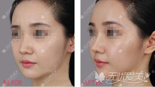 南京施尔美射极峰假体隆鼻真人案例