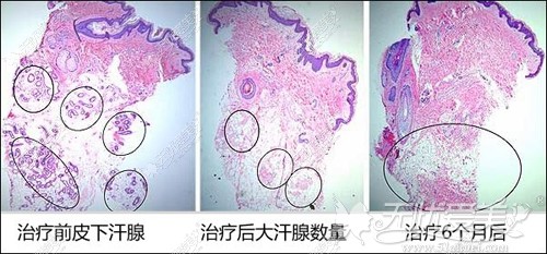 黄金微针微创祛腋臭效果