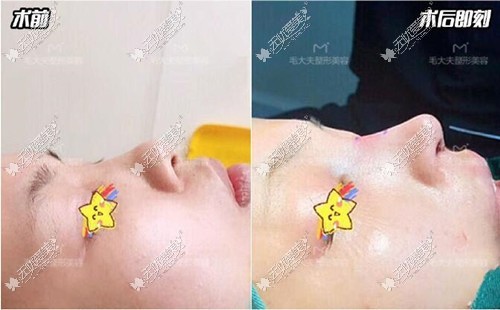 洛阳毛大夫普院长鼻综合案例