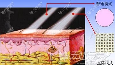 点阵激光祛疤的原理