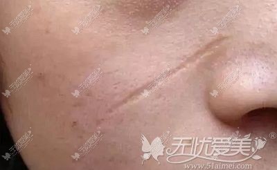 凹陷性疤痕可以用激光去除