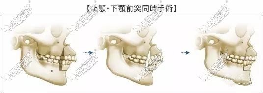 正颌手术的过程