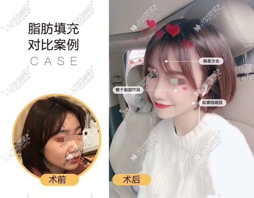 杭州艺星面部填充对比图