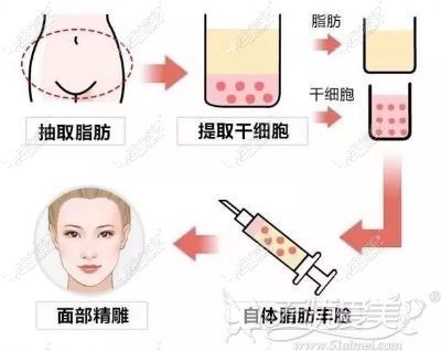 自体脂肪填充法令纹原理