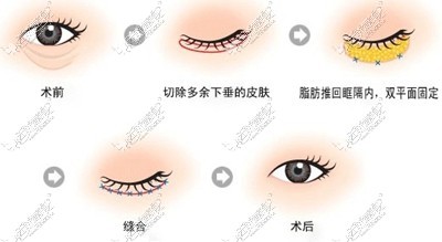 祛除眼袋手术过程