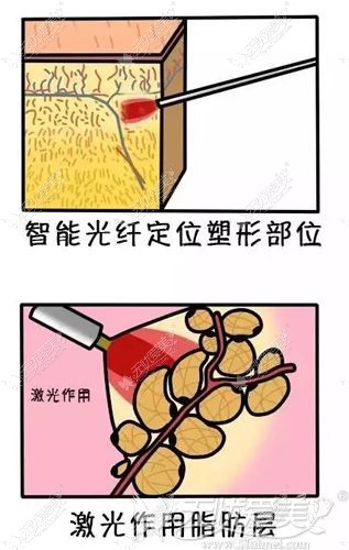 面部光纤溶脂原理