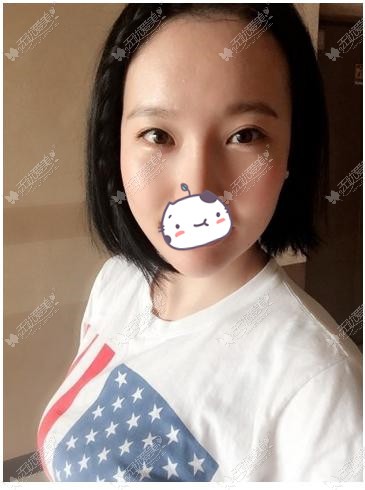 北京天使名源祛眼袋+注射瘦脸除皱术后