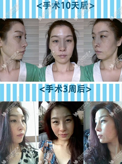 隆鼻修复