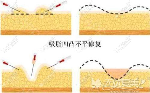 吸脂后凹凸不平可以先穿塑身衣解决
