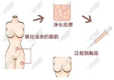 重庆自体脂肪隆胸