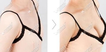 重庆自体脂肪隆胸案例