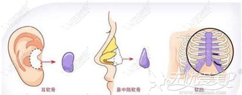 自体软骨隆鼻截取位置