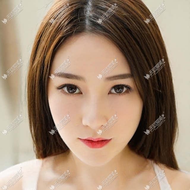 埋线法双眼皮手术简介