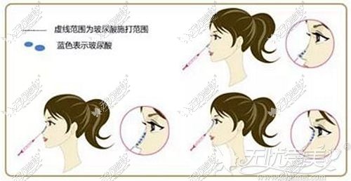 西宁时光玻尿酸隆鼻
