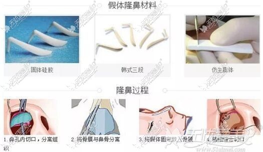 西宁时光假体隆鼻