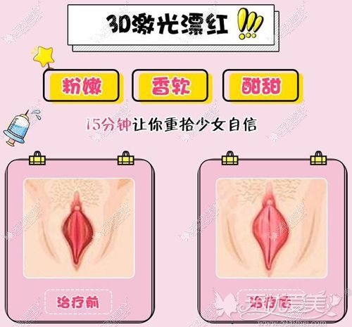 激光私密漂红的原理