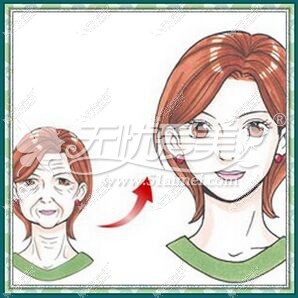 激光除皱