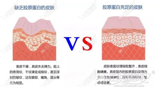 有无胶原蛋白皮肤对比